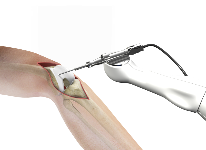 Computer-assisted Total Knee Replacement