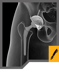 Acetabular Revision Surgery