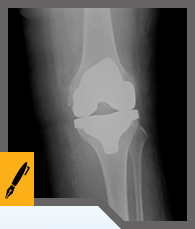 Knee Arthroscopy